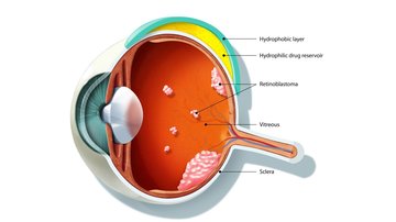Náš implantát dokáže pomoci v léčbě rakoviny očí, do klinické praxe je ale dlouhá cesta, říká chemik Širc