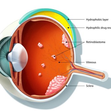 Náš implantát dokáže pomoci v léčbě rakoviny očí, do klinické praxe je ale dlouhá cesta, říká chemik Širc